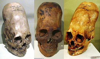Elongated Skull Phenomenon: Global Presence, DNA Analysis, Blood Type Anomalies And More